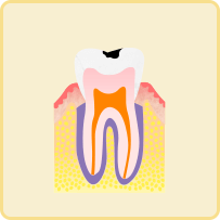 軽度のむし歯(C1)