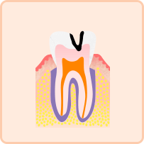 中度のむし歯(C2)