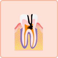 重度のむし歯(C3)