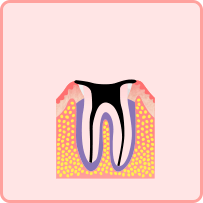 最重度のむし歯(C4)