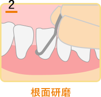 根面研磨