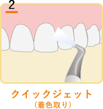 クイックジェット(着色取り)