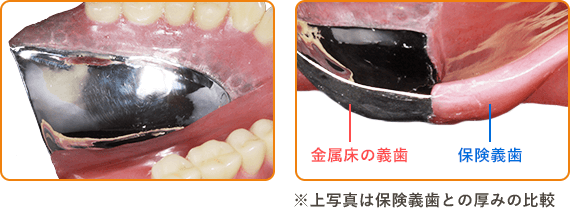 金属床義歯