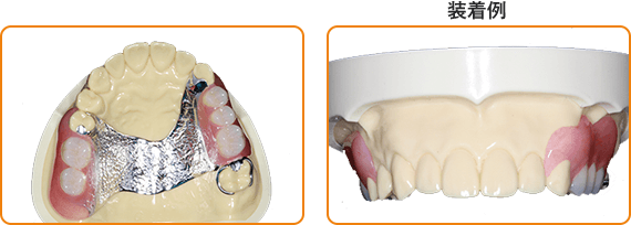 ノンクラスプ+金属床義歯