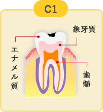 軽度のむし歯