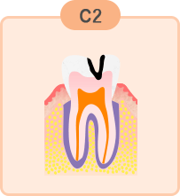 中度のむし歯