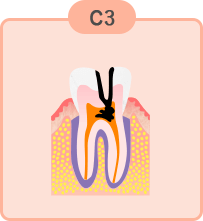 重度のむし歯