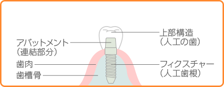 インプラント